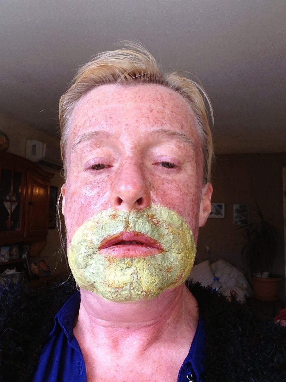 Deep phenol peel diary First three days of combination peel and after