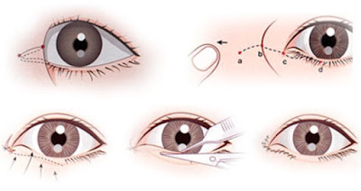 Phẫu thuật mở rộng góc mắt trong như thế nào (1)