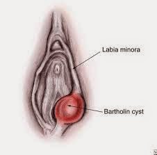 kista bartholin di kelamin wanita