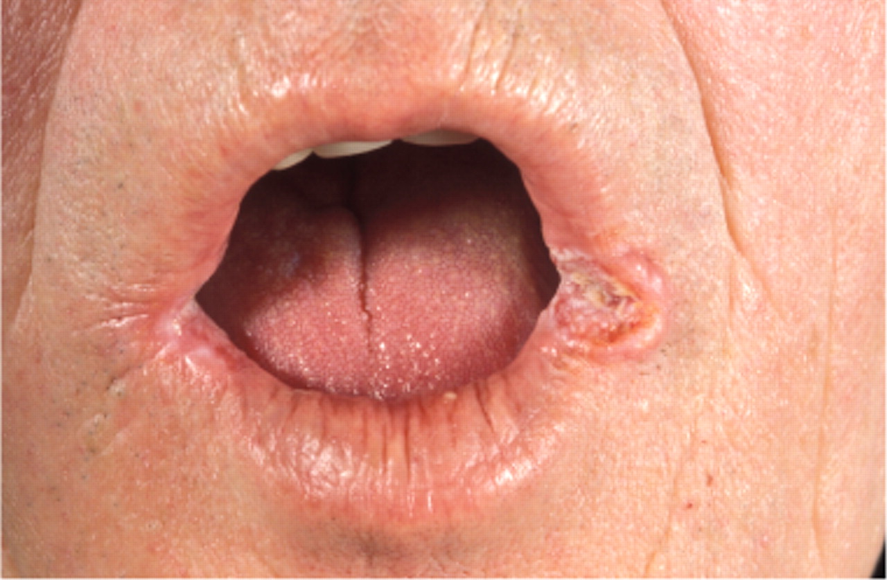 Angular cheilitis - Wikipedia