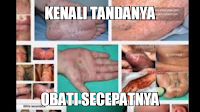 Cara Mengobati Penis Sakit Paling Mudah Cepat Sembuh