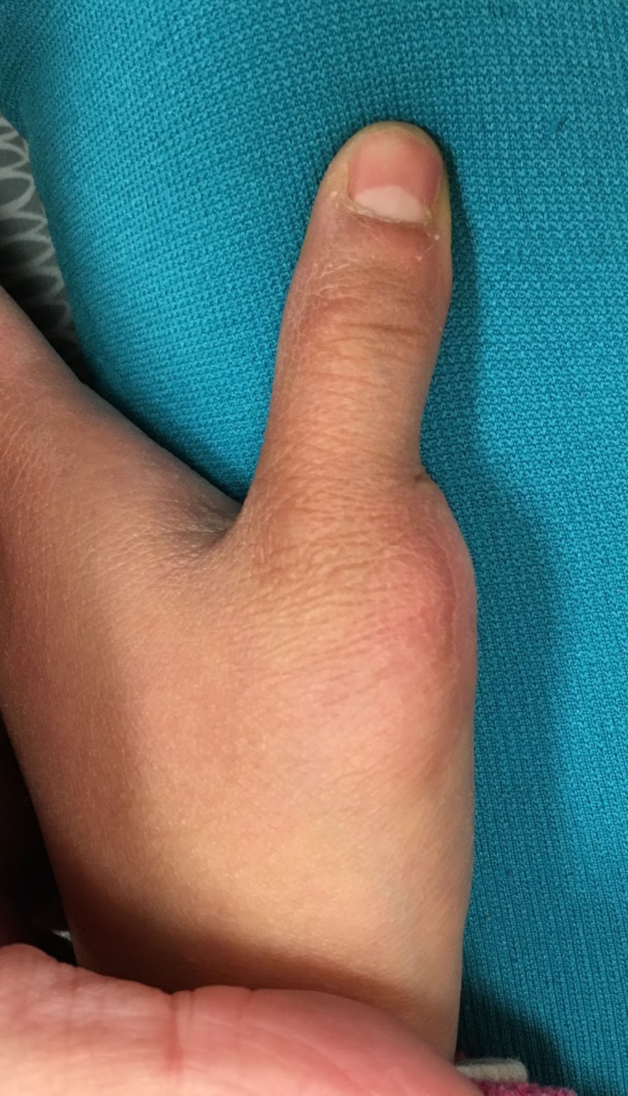 congenital-hand-and-arm-differences-2017