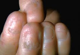 Me As Rare Epidermolysis Bullosa