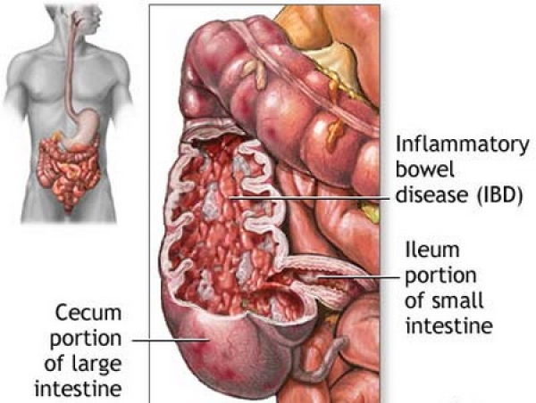 Amg Nursing In Gastroenterologie C6 Ingrijirea Pacientului Cu Rectocolita Hemoragica Cu Hemoragii Digestive