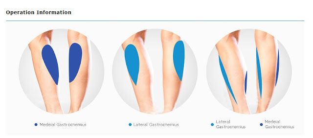 Apa itu operasi pengecilan betis?