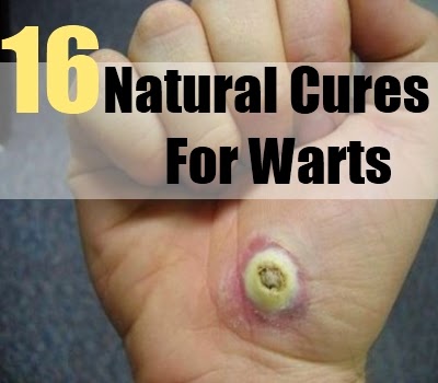 Natural Cures For Verrucas Natural Cures For Verrucas