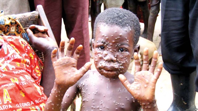 Monkeypox spreads in Lagos, six other states, cases rise to 31
