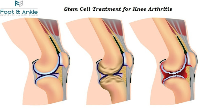 Stem Cell Treatment for Knee Arthritis