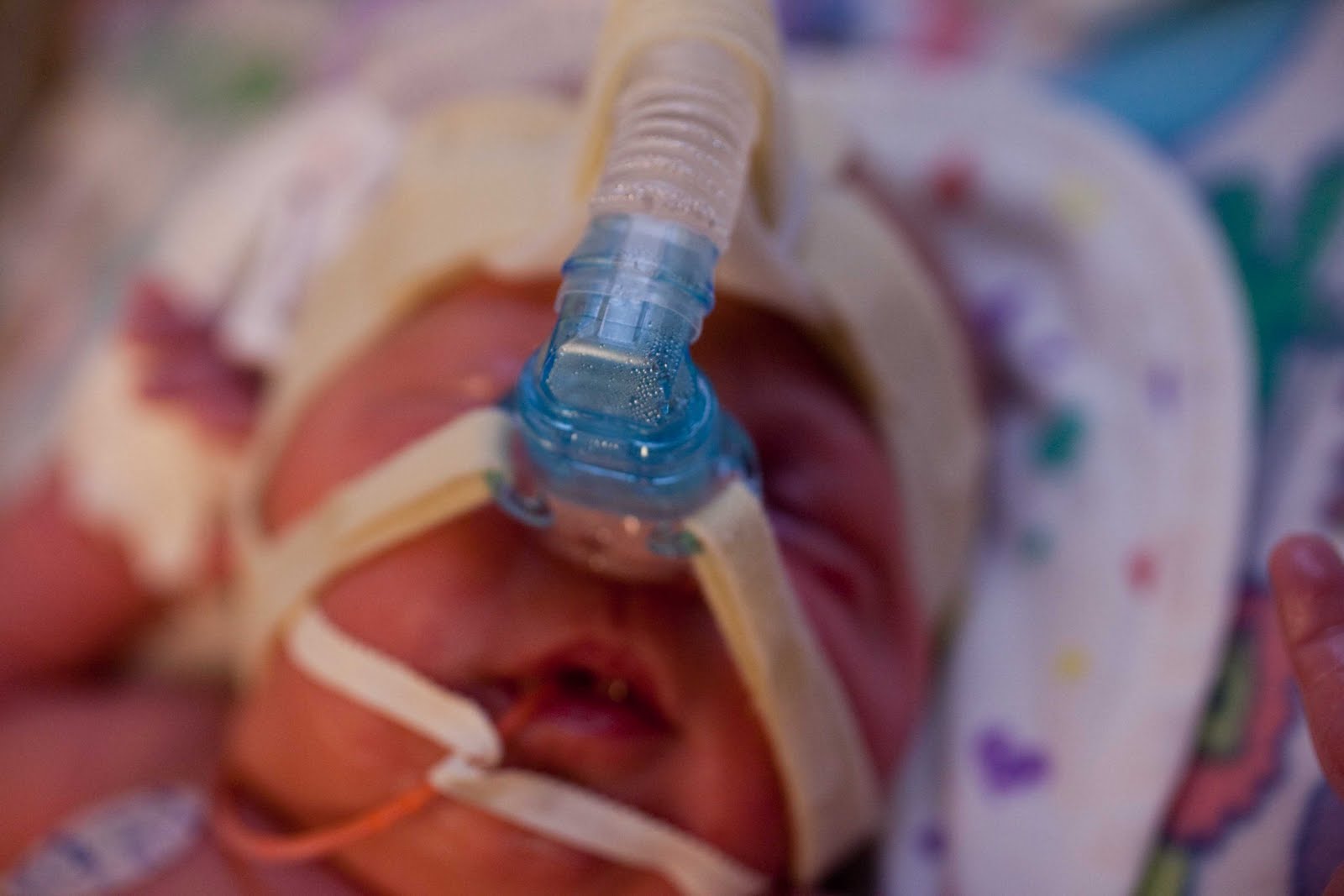 a moxley baby... CPAP.