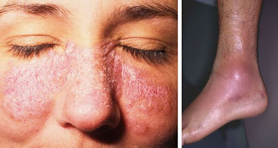 Obat Lupus Herbal Paling Ampuh dan Manjur Obat Lupus Herbal Paling Ampuh dan Manjur