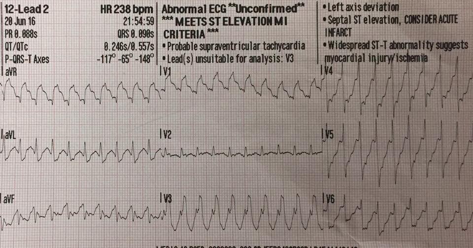 ECGs for EMS: SVT or VT or SVT ***Abnormal ECG Unfonfirmed***