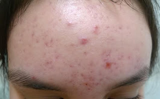 Como Quitar El Acne En La Frente Como Quitar El Acne En La Frente