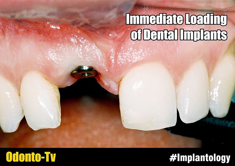 VIDEOCONFERENCING Immediate Loading of Dental Implants How to