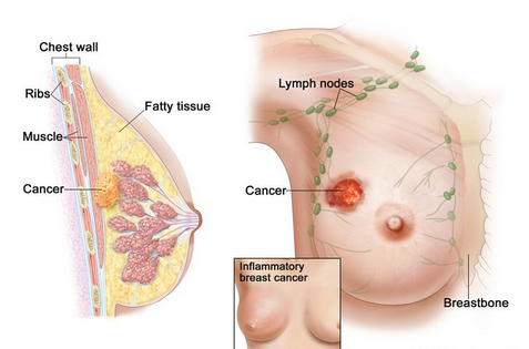 pengobatan kanker payudara tradisional stadium 2, obat kanker payudara alami stadium 1, obat kanker payudara stadium 4