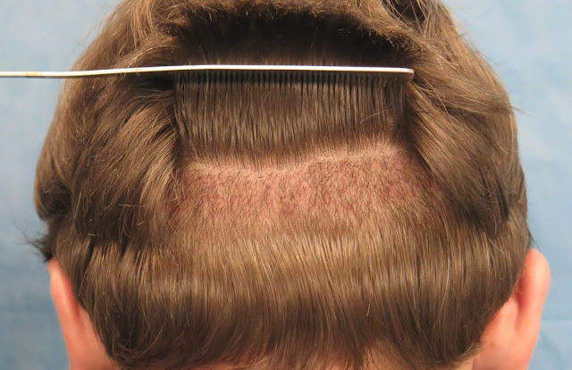 5 Ways Hair Transplants Can Do Wonders For You 3