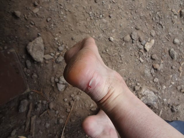 Blisters from hiking