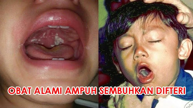 Terlambat Atasi Difteri Sebabkan Kematian, Manfaatkan 4 Bahan Alami Ampuh Menyembuhkannya 