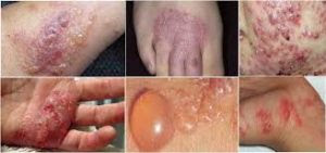 Obat Tradisional Gatal Berair di Tangan Dan Kaki Obat Tradisional Gatal Berair di Tangan Dan Kaki