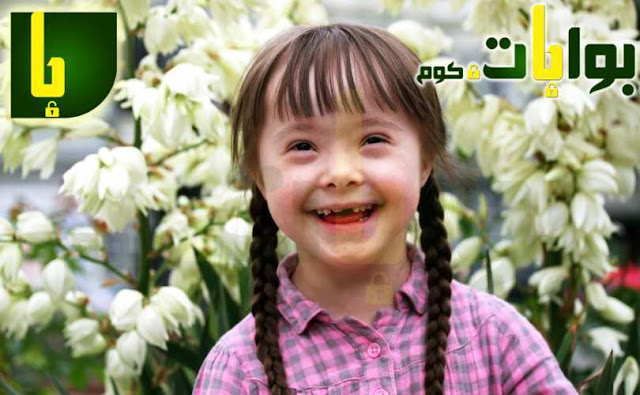 متلازمة داون (الطفل المنغولي)