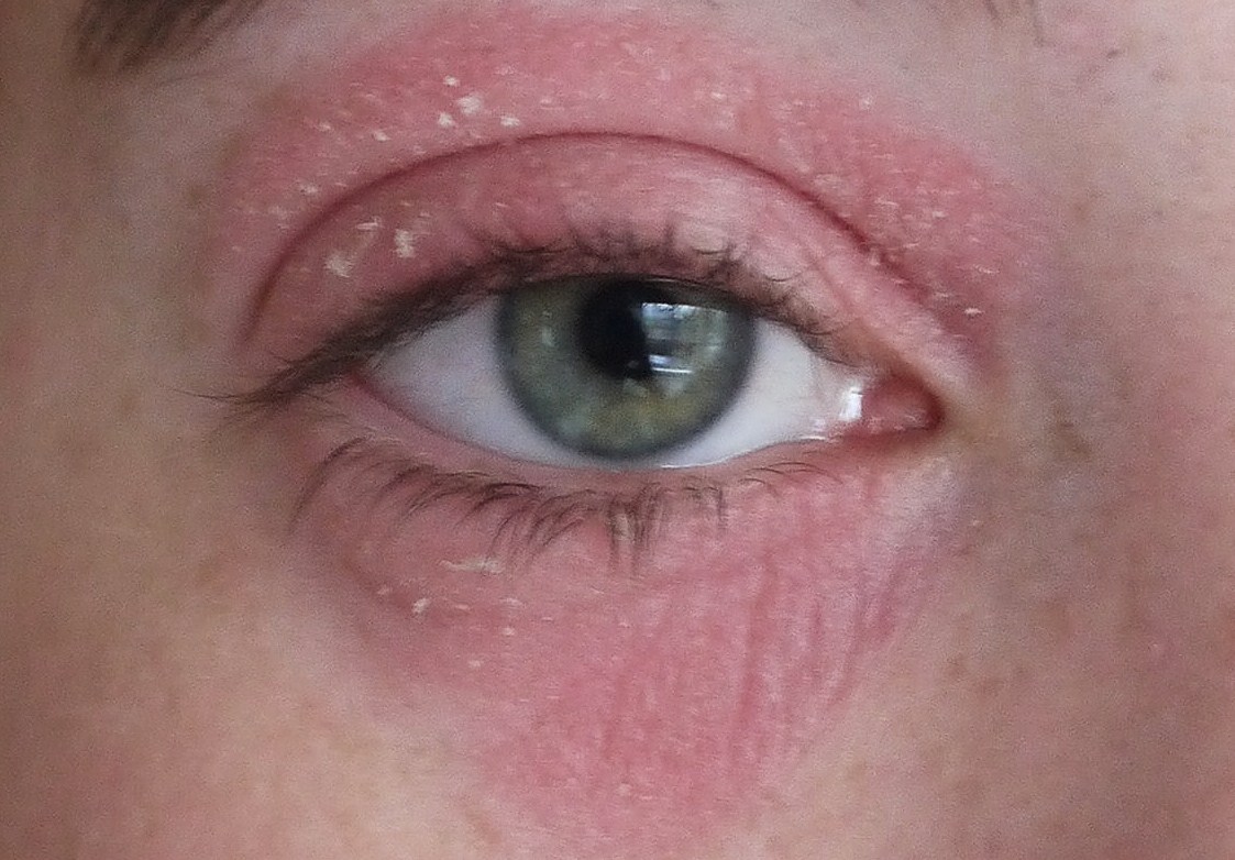 My Struggle With Eczema On Face and Eyes & My Miracle ...