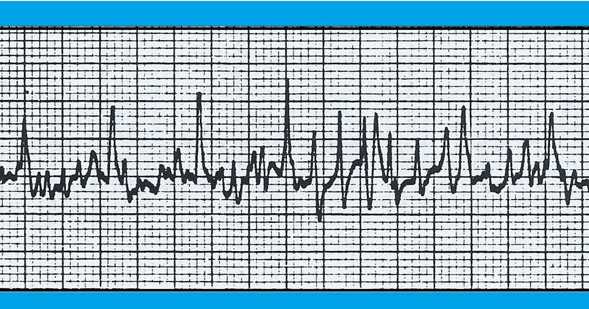 ECG Interpretation ECG Blog 132 (Ventricular Tachycardia VT Vfib