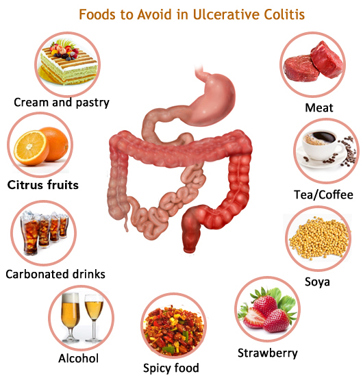 Foods to avoid, ulcerative colitis, inflammatory bowel disease, crohns disease