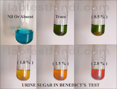 Urine sugar in Benedict's Test