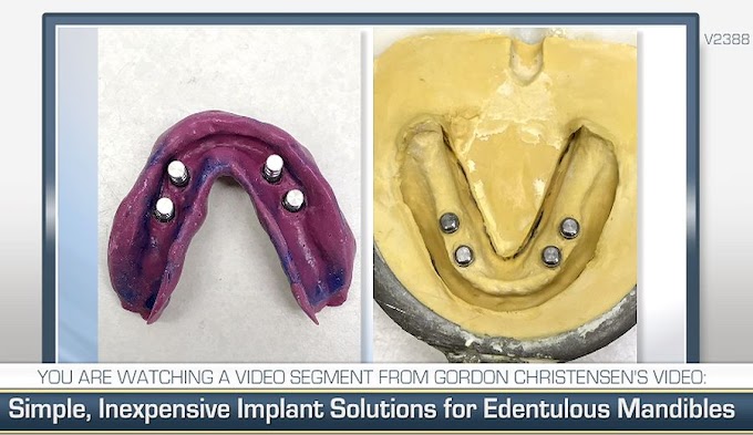 PROSTHODONTICS: Simple, Inexpensive Implant Solutions for Edentulous Mandibles
