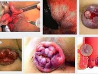 Obat Super Manjur Hilangkan Wasir Yang Sudah Kronis Obat Super Manjur Hilangkan Wasir Yang Sudah Kronis