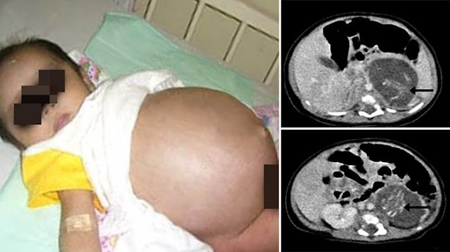 Bayi Lahir Dengan Kondisi Perut Buncit, Ternyata 2 Makhluk Ini Bersarang Di Rahimnya! Bayi Lahir Dengan Kondisi Perut Buncit, Ternyata 2 Makhluk Ini Bersarang Di Rahimnya!