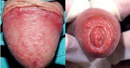 Si es posible beber el kéfir a atopicheskom la dermatitis