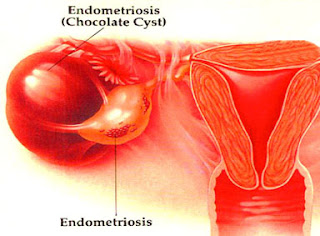 Mengobati Endometriosis Tanpa Operasi