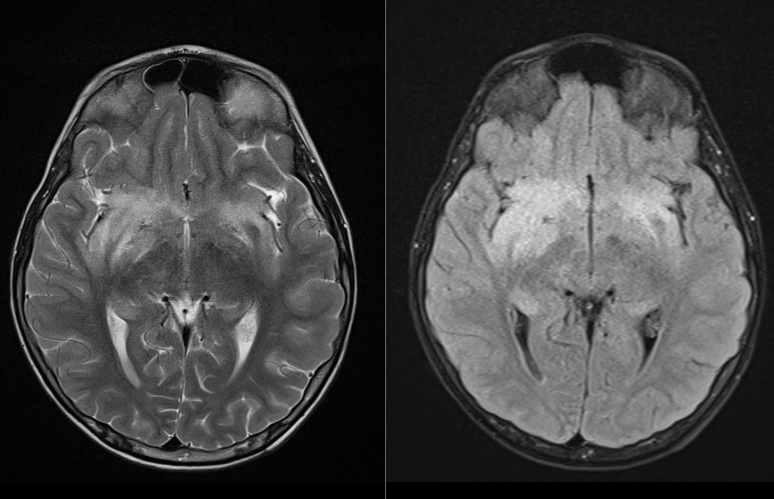 Herpes Simplex Encephalitis