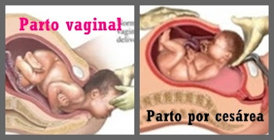 Parto vaginal o parto por cesárea programado ?a la carta?