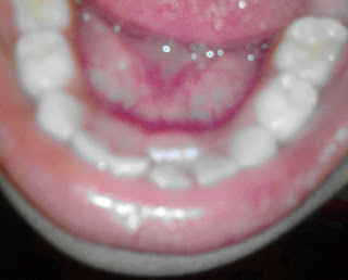 Anak demam tumbuh gigi kekal gigi susu patah