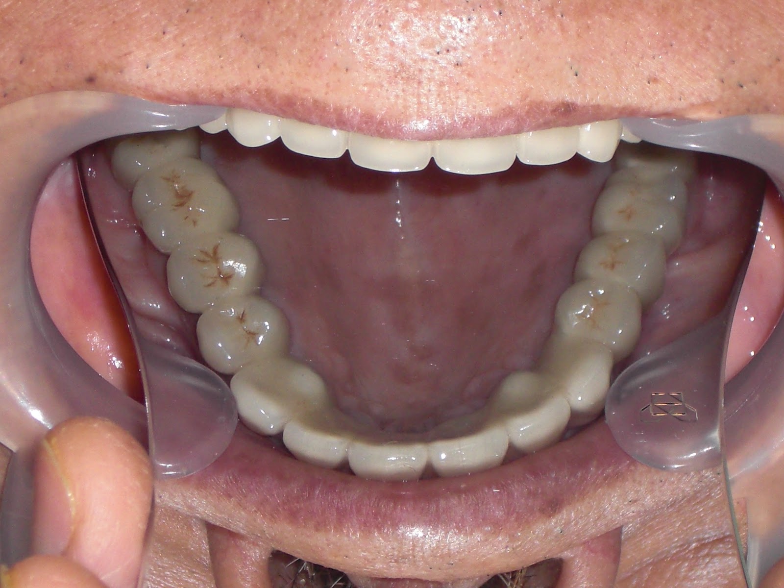Dental Implantology: THE RESCUE OF A DENTAL CRIPPLE AND A LIFE TRANSFORMED