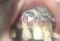 female patient with maggots covering her top gum and teeth, Dentist recorded this shocking video of his patient in india, Live Maggots in mouth
