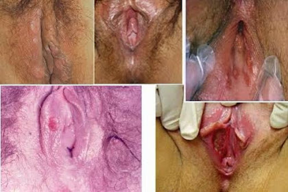 Obat Luka Lecet Pada Bagian Dalam Vagina