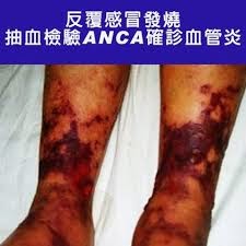 反覆感冒發燒 抽血檢驗ANCA確診血管炎