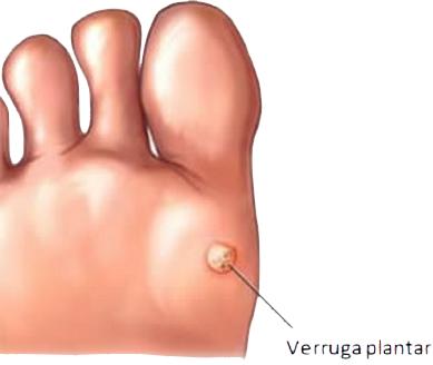 La NMG - Perú: Caso: Verruga en la planta del pie
