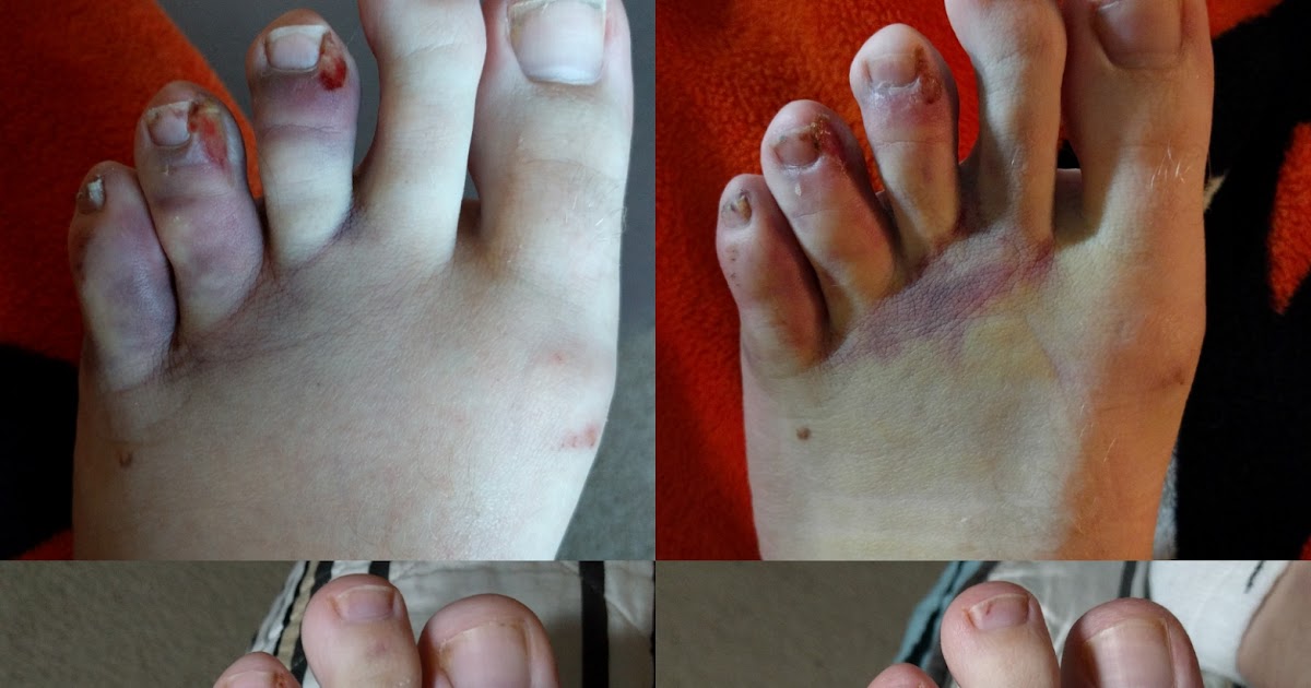 Thomas' Blog WARNING GROSS FOOT PICTURES
