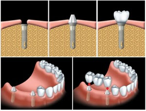 Nên làm răng implant hay cầu răng giả?