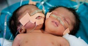 5 Bayi Aneh Bin Ajaib Yang Lahir di Dunia 5 Bayi Aneh Bin Ajaib Yang Lahir di Dunia