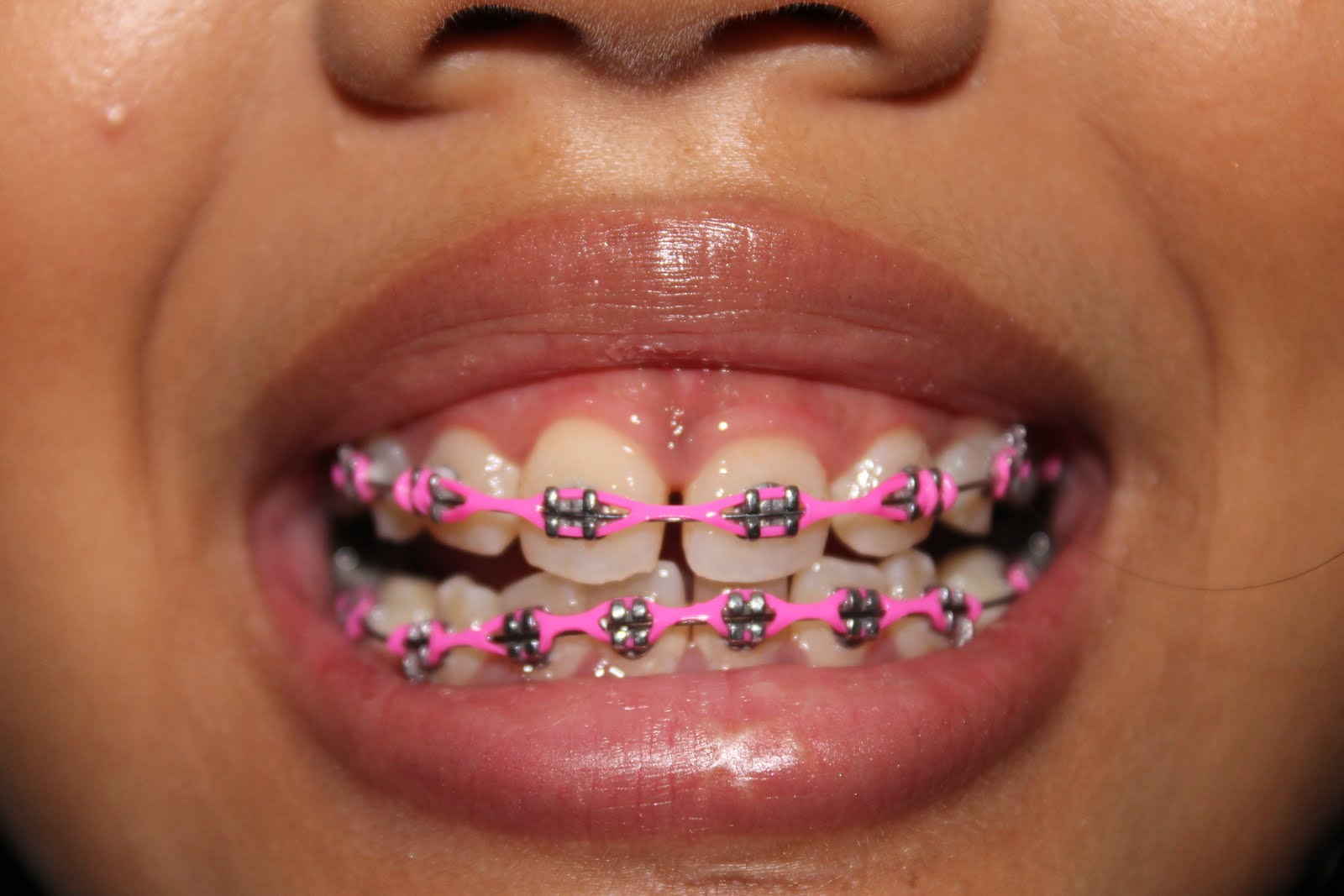 Life, Love, Everything Braces UPDATE!