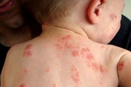 Cara Mengobati Penyakit Kaligata Pada Anak 2 Tahun Dengan Obat Herbal Cara Mengobati Penyakit Kaligata Pada Anak 2 Tahun Dengan Obat Herbal