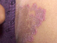 gatal eksim Dermatitis