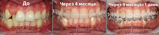 Брекеты на нижний зубной ряд устанавливаем через 4 месяца после установки на верхнюю челюсть. прикуса до лечения, четыре месяца брекеты на верхней челюсти и установка брекетов на нижней челюсти