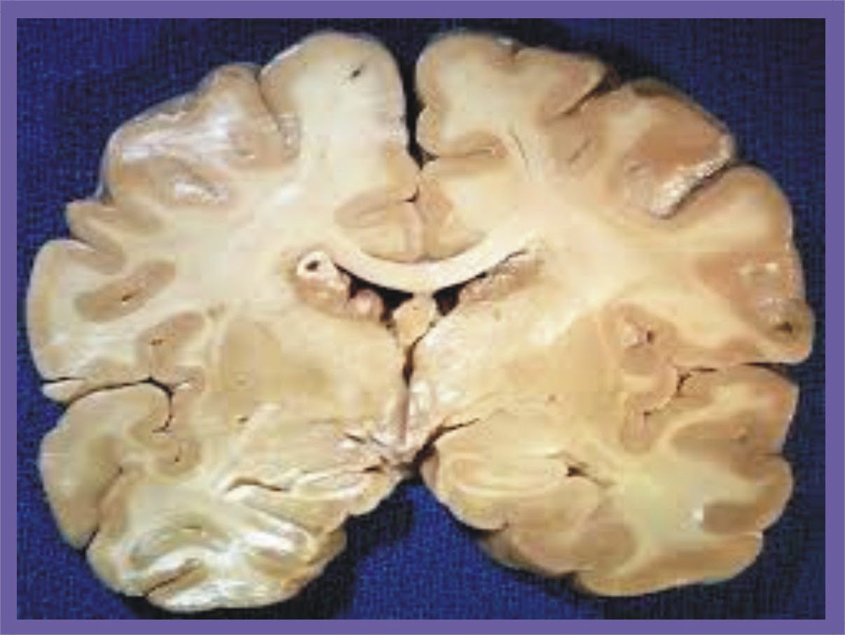 Атрофия мозга у взрослого. Атрофия головного мозга патанатомия. Туберозный рассеянный склероз. Гидроцефалия головного мозга макропрепарат. Макропрепарат туберозный глиоз.