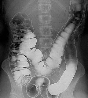 Human intestinal tract imaged with barium contrast medium (X-ray)
