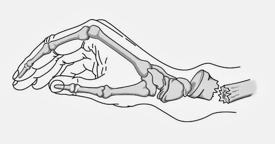 fratura de colles fisioterapia